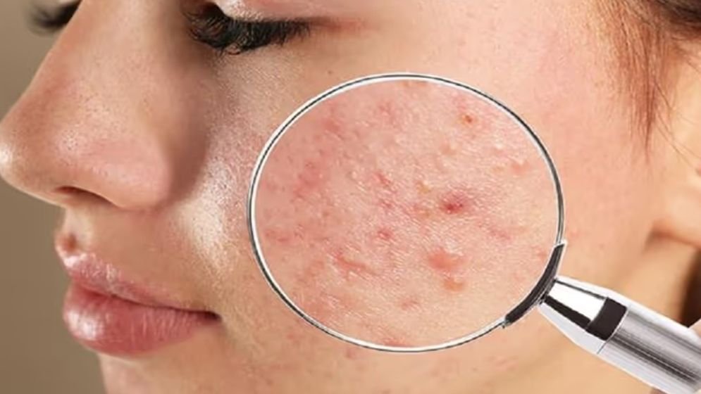 মানসিক চাপ ও ত্বক: ব্রণ ও চর্মরোগের অজানা সংযোগ